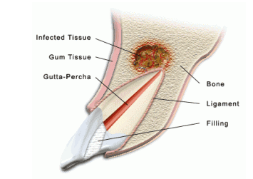 Endodontic surgery